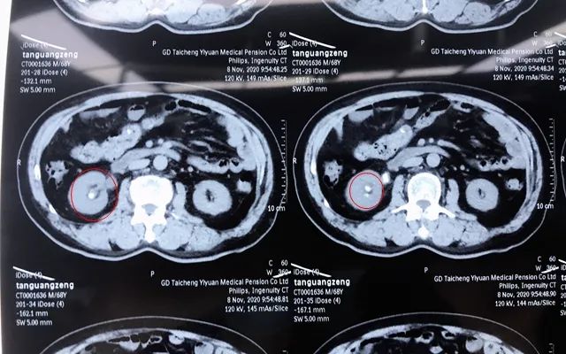 重磅！经皮肾镜取石术（PCNL）——治疗泌尿系结石新技术