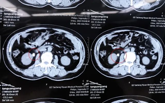 重磅！经皮肾镜取石术（PCNL）——治疗泌尿系结石新技术