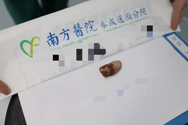 【医疗技术】南方医院泰成逸园分院成功完成高难度拇指断指再植术