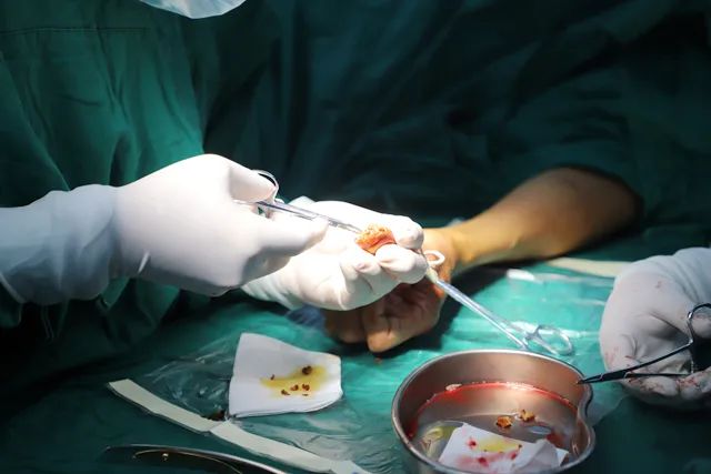 【医疗技术】南方医院泰成逸园分院成功完成高难度拇指断指再植术