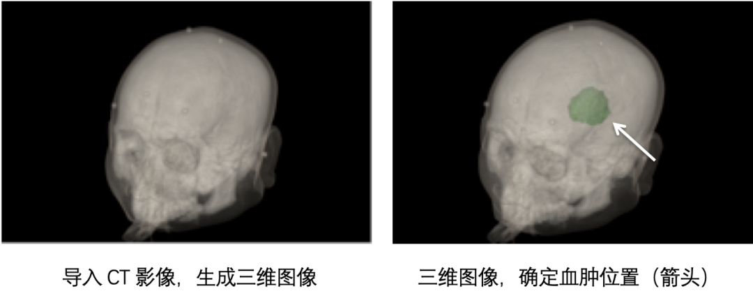 南方医院神经内科开展无框架立体定向脑出血血肿清除术，快速微创清除血肿