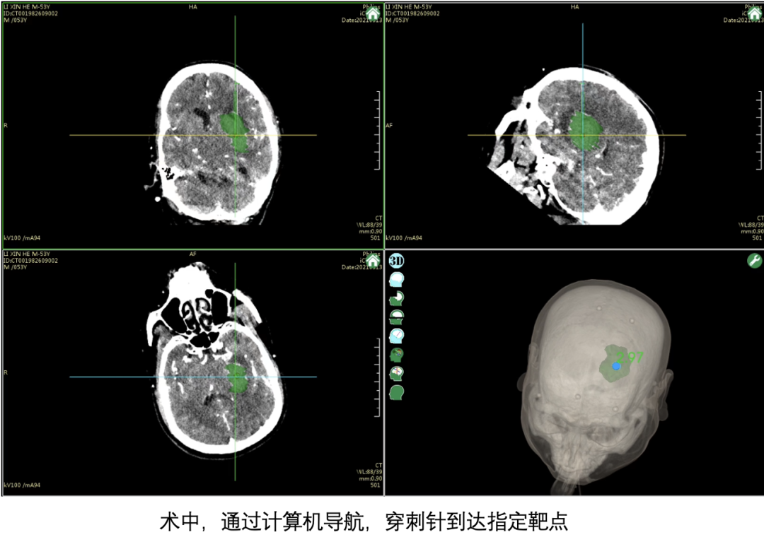 南方医院神经内科开展无框架立体定向脑出血血肿清除术，快速微创清除血肿