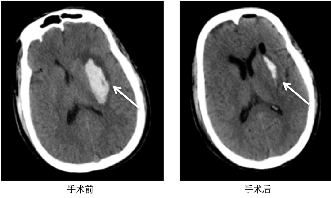 南方医院神经内科开展无框架立体定向脑出血血肿清除术，快速微创清除血肿