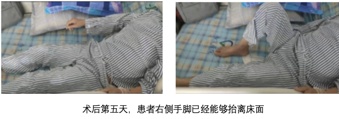 南方医院神经内科开展无框架立体定向脑出血血肿清除术，快速微创清除血肿