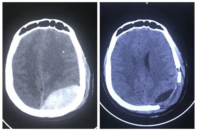 【医技动态】南方医院泰成逸园分院外科成功开展颅骨缺损修补术