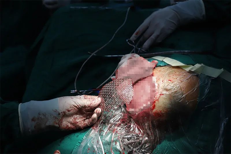 【医技动态】南方医院泰成逸园分院外科成功开展颅骨缺损修补术