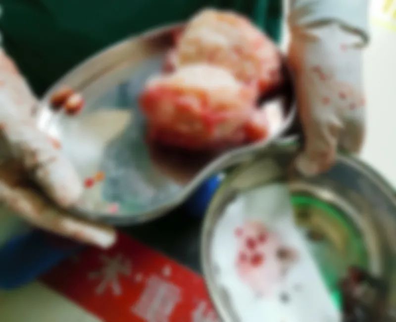 妙手施仁术，我院妇科专家成功为多发巨大子宫肌瘤患者进行手术并保留子宫