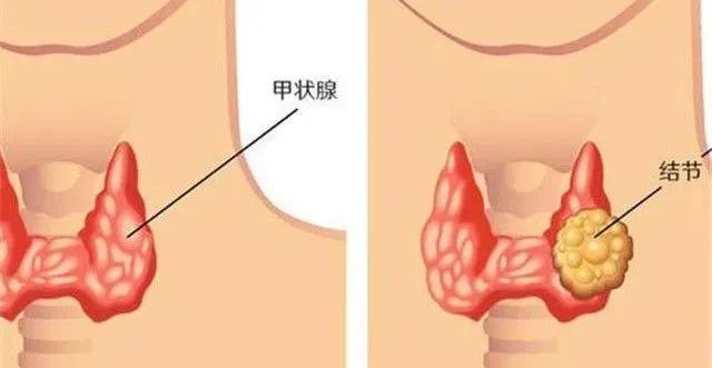 泰成逸园医院外科顺利完成一例甲状腺癌根治手术