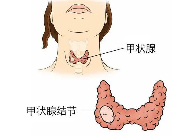 体检发现甲状腺结节莫慌！泰成逸园医院外科主任告诉您怎么处理？