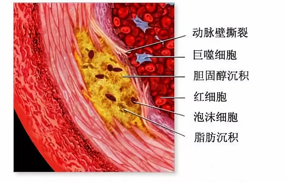 节后警惕 || 千万别让血栓找你麻烦！打牌、刷剧久坐不动是诱因→