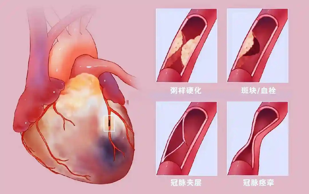秋天心梗高发！泰成逸园医院心血管专家提醒，做好10个生活细节很关键！