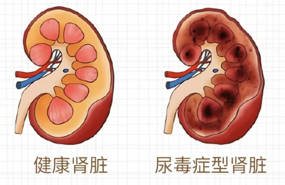 头晕、恶心、呕吐？可能是尿毒症的“信号灯”身体出现这些征兆需警惕！