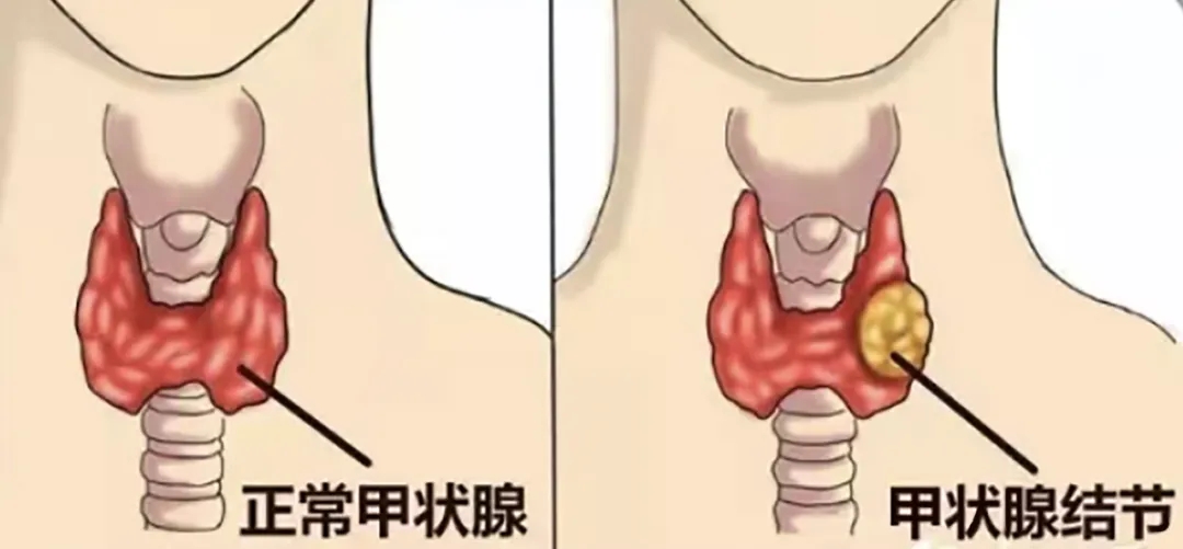 体检发现甲状腺结节？别慌，超声科主任为您解答！