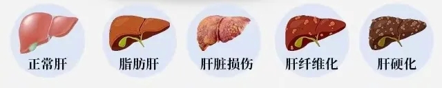 3.18全国爱肝日｜警惕肝变“硬”，避免大动“肝”戈