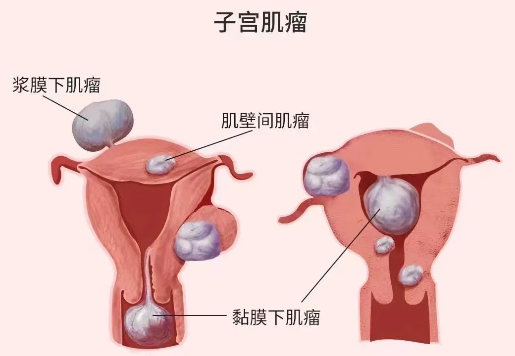 子宫肌瘤ㅣ女性健康的“小麻烦”，该如何应对？一文带你全面了解！