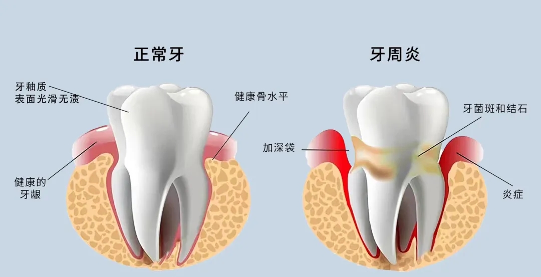 牙齿问题，远不止“影响吃饭”这么简单！它可能正在悄悄摧毁全身健康。
